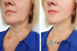 Double chin before and after Hi-Fu treatment 4 Book your double chin treatment Luton today! We are here to help!