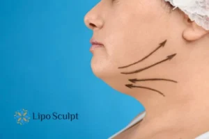 Double chin before and after Hi-Fu treatment 3 Boost your confidence with a Double chin treatment Luton