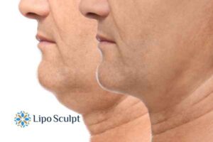 Double chin before and after Hi-Fu treatment 2 Double chin treatment Luton from Lipo Sculpt - feel more confident today!