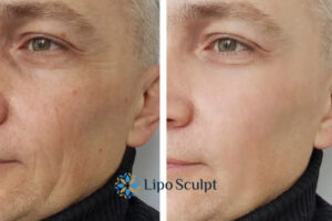 How to Fight Aging Symptoms 3 Fight Aging Symptoms Luton With HIFU and Morpheus8 Today!