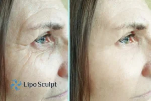 How to Fight Aging Symptoms 2 Do you want to Fight Aging Symptoms Luton? Contact Lipo Sculpt today!