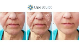 Explaining Morpheus8 And What It Can Do For You 3 Boost your confidence with Morpheus8 Luton call our team today!
