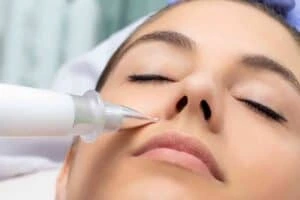 Best Actinic Keratoses Removal 3 Actinic keratoses Luton solutions - book in today!