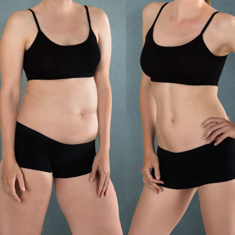 CoolSculpting for Legs: What Cryolipolysis Can and Can’t Do 3 before and after Cryolipolysis