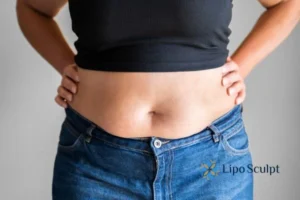Bidding Farewell to Muffin Tops with Aqualyx Fat Injections 2 Do you wish you could reduce your muffin top Luton With Aqualy fat dissolving injections you can!