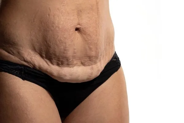 Lost the Weight but Not the Loose Skin? 1 image of womans stomach after weight loss showing loose skin Luton